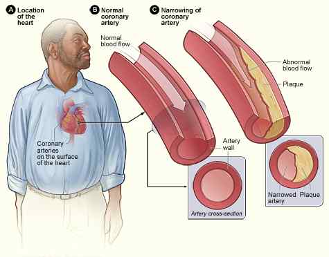 Diferencia entre la enfermedad de la arteria coronaria y la aterosclerosis