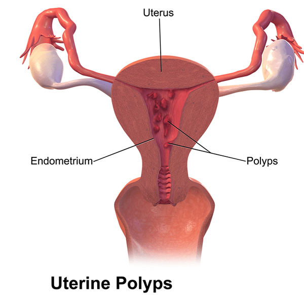 Unterschied zwischen Zyste und Polyp