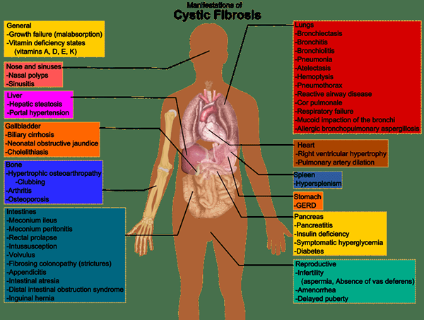 Diferencia entre la fibrosis quística y la fibrosis pulmonar