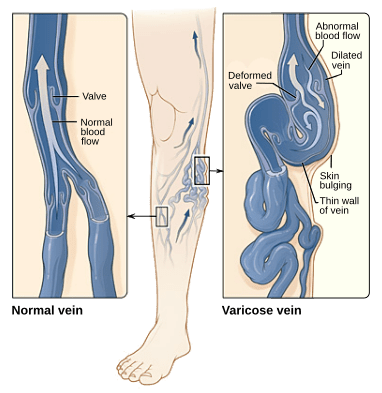 Perbedaan antara trombosis vena dalam dan varises