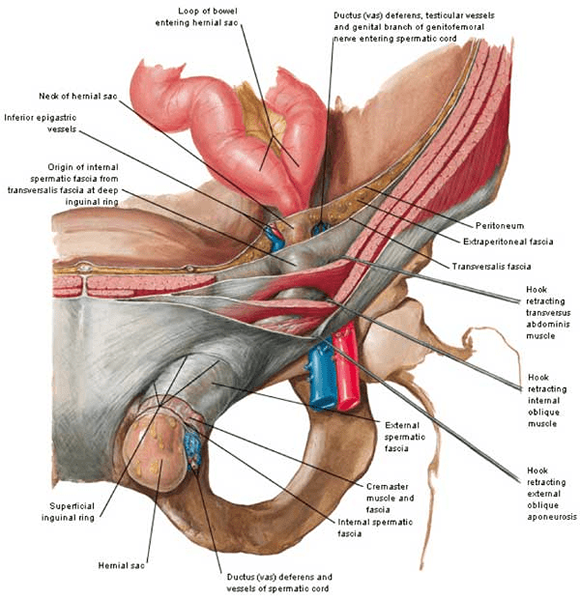 Diferencia entre hernia inguinal directa e indirecta