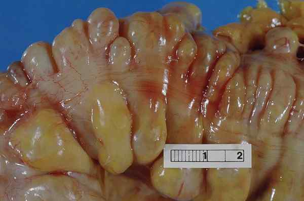 Unterschied zwischen Divertikulitis und Colitis ulcerosa