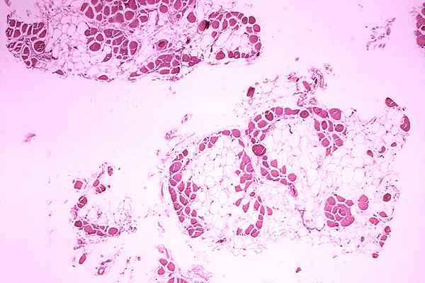 Diferencia entre la distrofia muscular de Duchenne y Becker