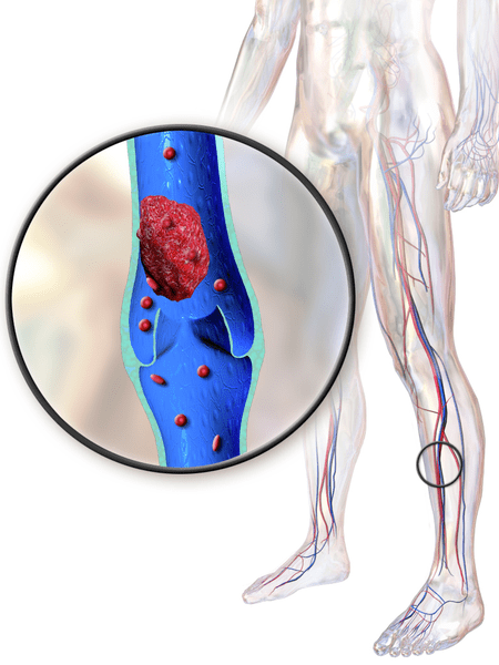 Diferencia entre DVT y PAD