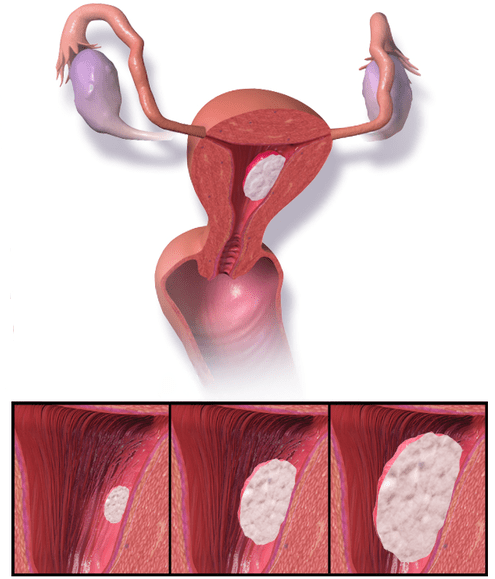 Différence entre l'endométriose et le cancer de l'endomètre