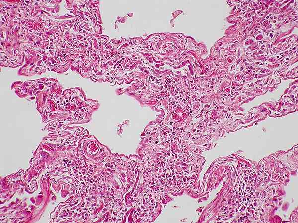 Perbezaan antara fibrosis dan sirosis