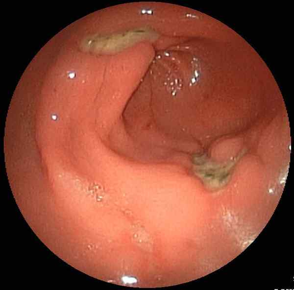 Diferencia entre gastritis y úlcera duodenal