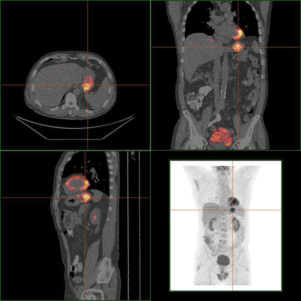 Unterschied zwischen Gastritis und Gastroenteritis