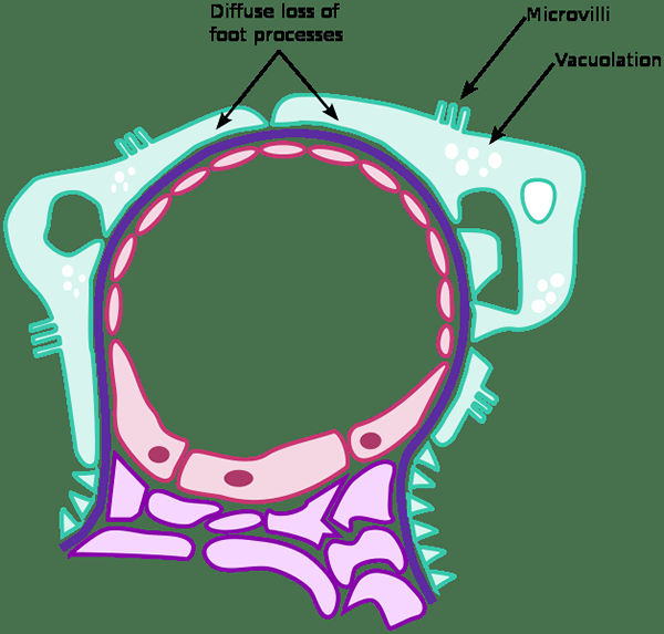 Diferencia entre glomerulonefritis y síndrome nefrótico