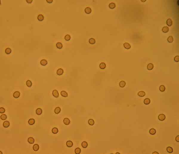 Perbedaan antara hematuria dan hemoglobinuria