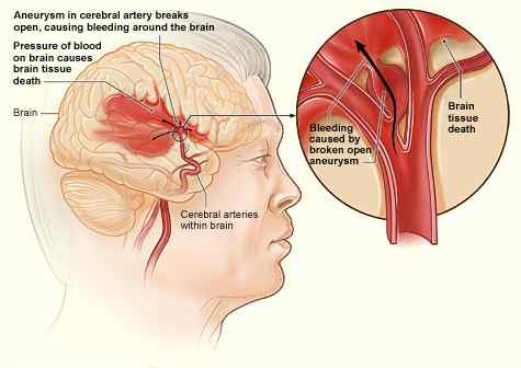 Perbedaan antara perdarahan dan hematoma