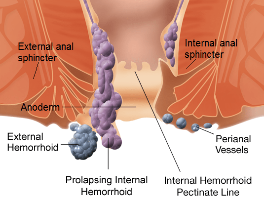 Différence entre la hernie et l'hémorroïde