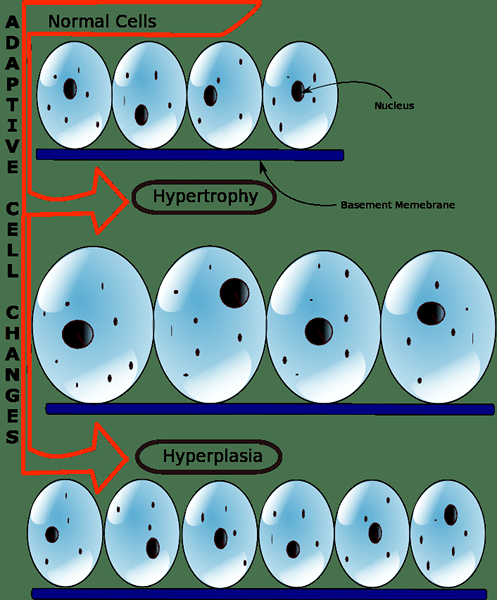 Diferencia entre hiperplasia y neoplasia