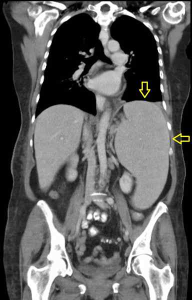 Unterschied zwischen Hypersplenismus und Splenomegalie