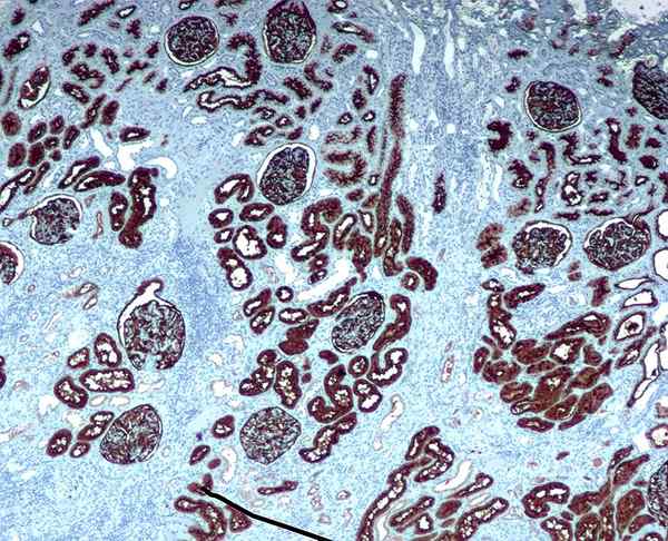 Diferencia entre inmunocitoquímica e inmunohistoquímica