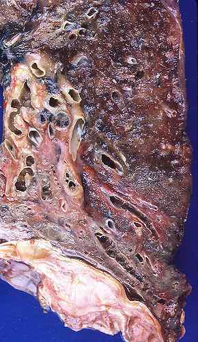 Diferencia entre la enfermedad pulmonar intersticial y los bronquiectasis