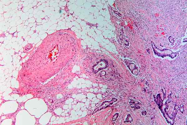 Perbezaan antara pencerobohan dan metastasis