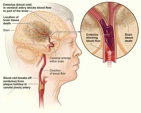 Perbezaan antara strok iskemia dan hemorrhagic