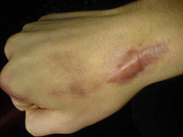 Différence entre la cicatrice chéloïde et hypertrophique