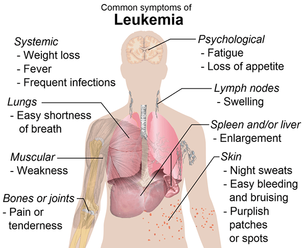 Diferencia entre leucemia y mieloma múltiple