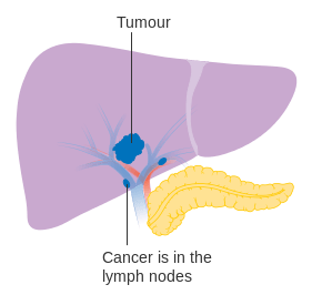 Diferencia entre la cirrosis hepática y el cáncer de hígado