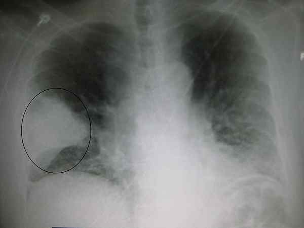 Diferencia entre la neumonía lobar y la broncopneumonía