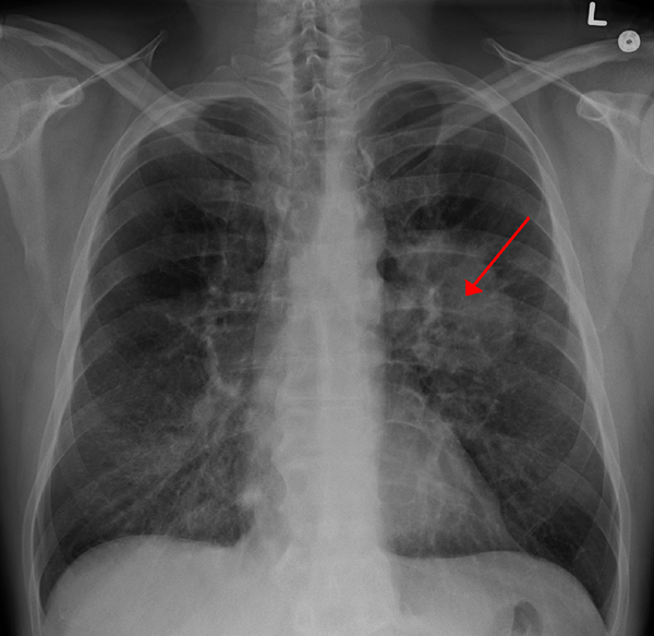 Perbezaan antara kanser paru -paru dan tuberkulosis