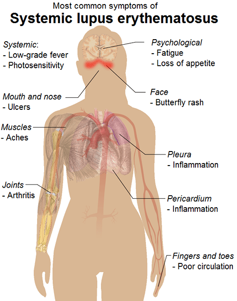 Diferencia entre el lupus y la fibromialgia