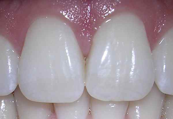 Diferencia entre el incisor maxilar central y lateral