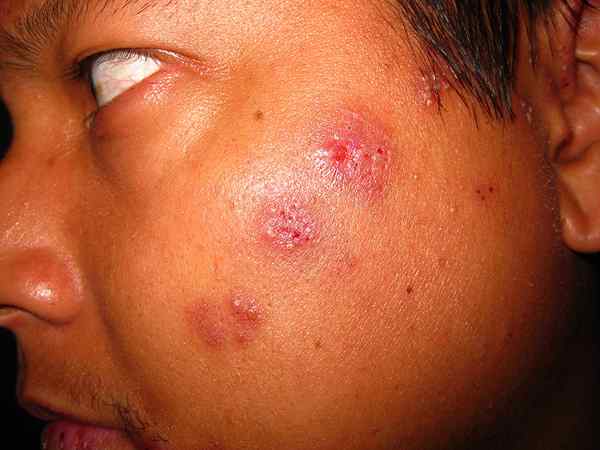 Perbedaan antara campak dan herpes zoster
