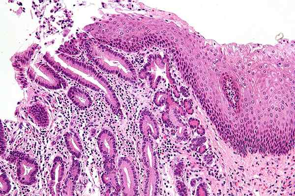 Diferencia entre metaplasia y displasia