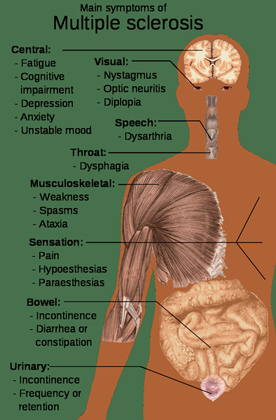 Diferencia entre la esclerosis múltiple y la enfermedad de las neuronas motoras