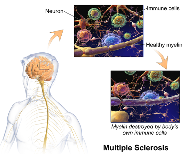 Perbedaan antara multiple sclerosis dan sklerosis sistemik