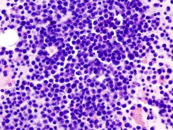 Perbezaan antara myeloma dan limfoma