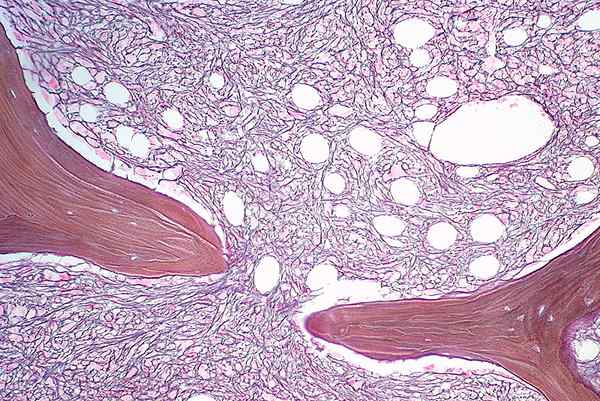 Perbezaan antara myeloproliferative dan myelodysplastic