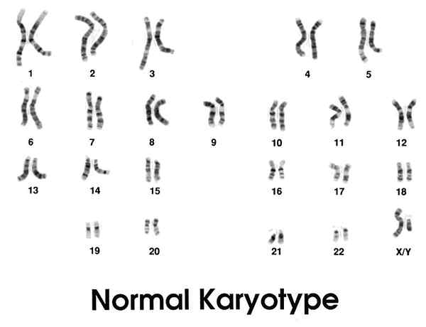 Perbezaan antara karyotype normal dan tidak normal