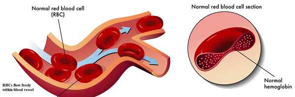 Unterschied zwischen normalem Hämoglobin und Sichelzellen -Hämoglobin