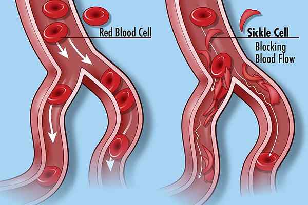 Différence entre les globules rouges normaux et la drépanocytose