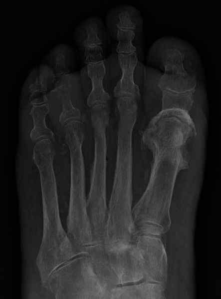 Unterschied zwischen Osteomyelitis und septischer Arthritis