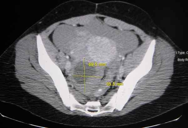 Différence entre le kyste ovarien et le cancer de l'ovaire