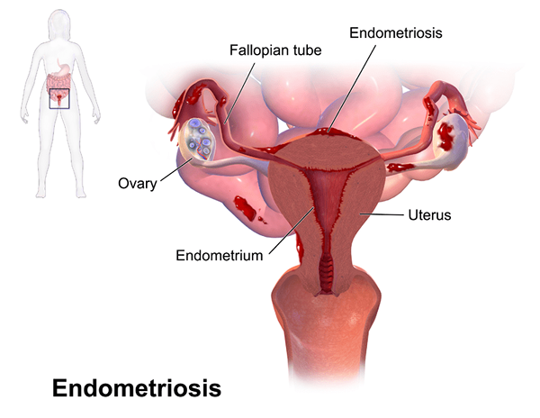 Perbezaan antara PCOS dan endometriosis