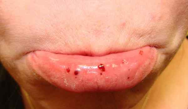 Perbezaan antara petechiae purpura dan ecchymosis