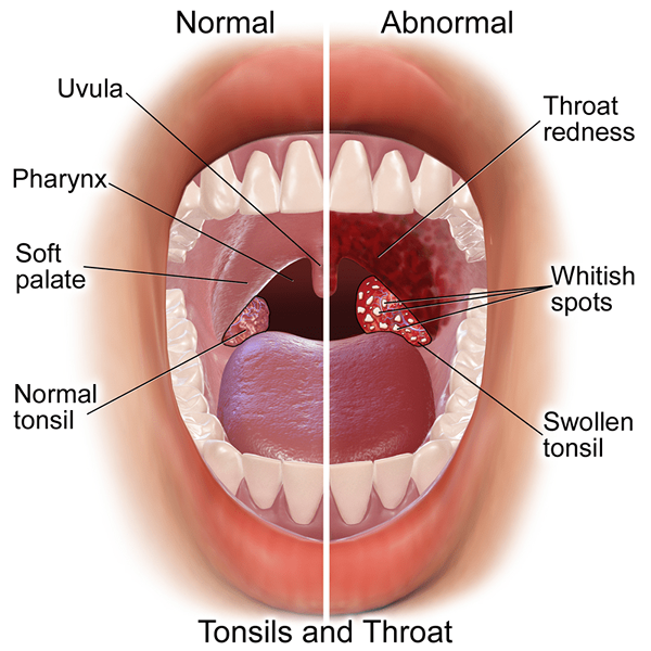 Unterschied zwischen Pharyngitis und Mandelentzündung