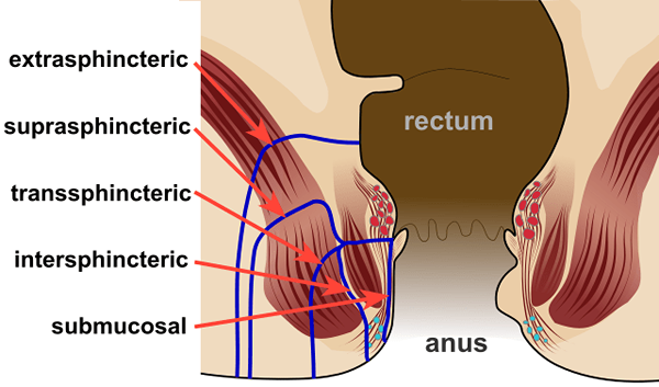 Perbedaan antara tumpukan dan fistula