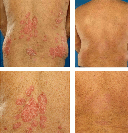 Différence entre le psoriasis en plaque et le psoriasis