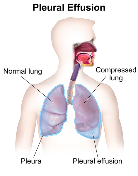 Perbezaan antara efusi pleural dan radang paru -paru