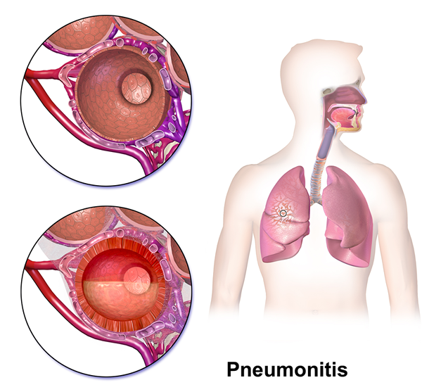 Diferencia entre neumonía y neumonitis