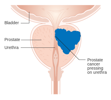 Diferencia entre el cáncer de próstata y el cáncer testicular
