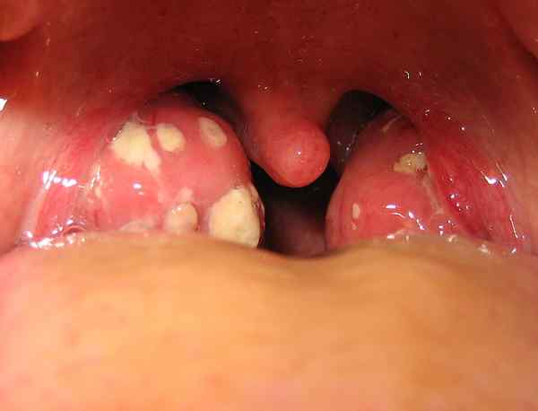 Diferencia entre la cardiopatía reumática y la endocarditis infecciosa