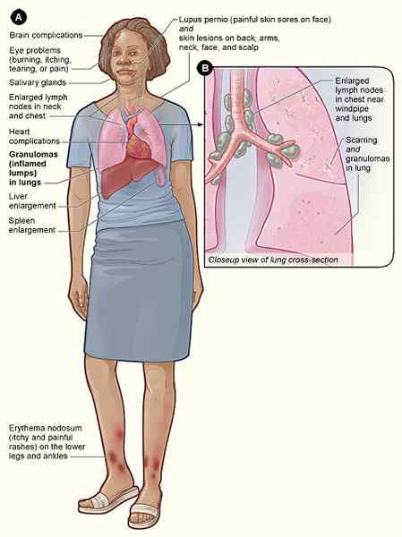 Diferencia entre sarcoidosis y tuberculosis